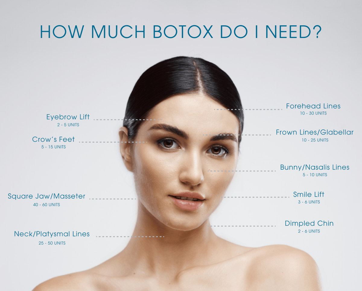 Botox Face Diagram