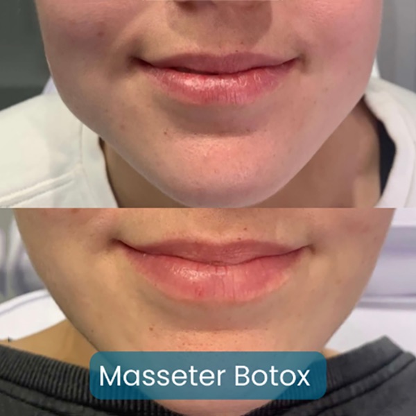 Botox for Teeth Grinding and TMJ