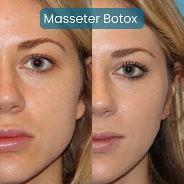 Botox for Teeth Grinding and TMJ Charleston | Ageless Medical Spa