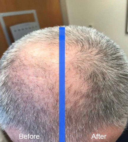 Hair Restoration