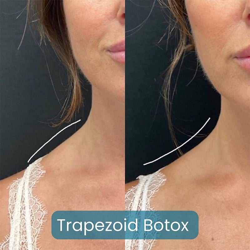 Botox for Headaches Before & After Image