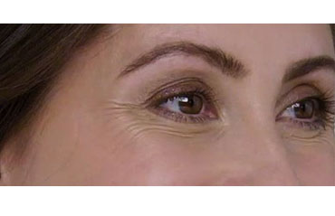 BOTOX Before & After Image