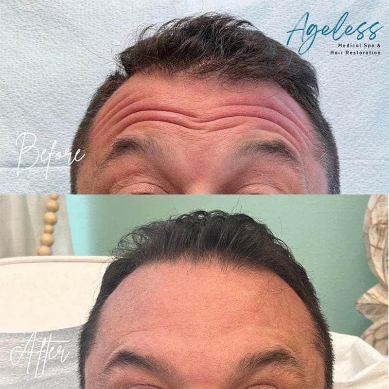 BOTOX Before & After Image
