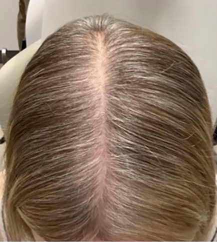 Hair Restoration Before & After Image