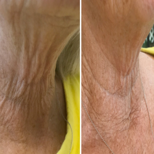Dermal Repair | Skin Resurfacing Before & After Image
