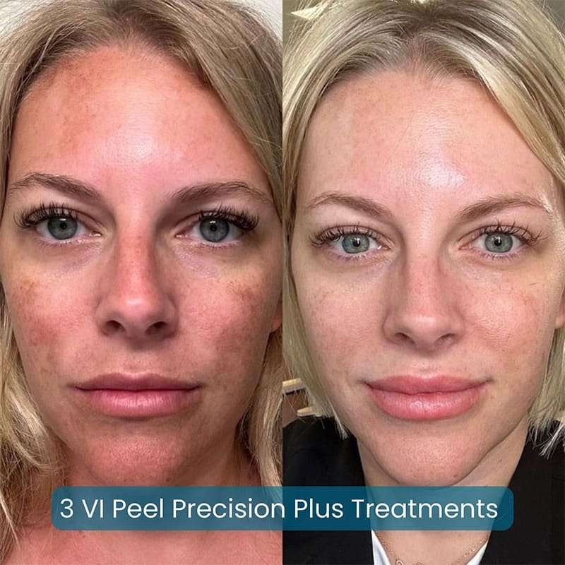 Chemical Peels Before & After Image