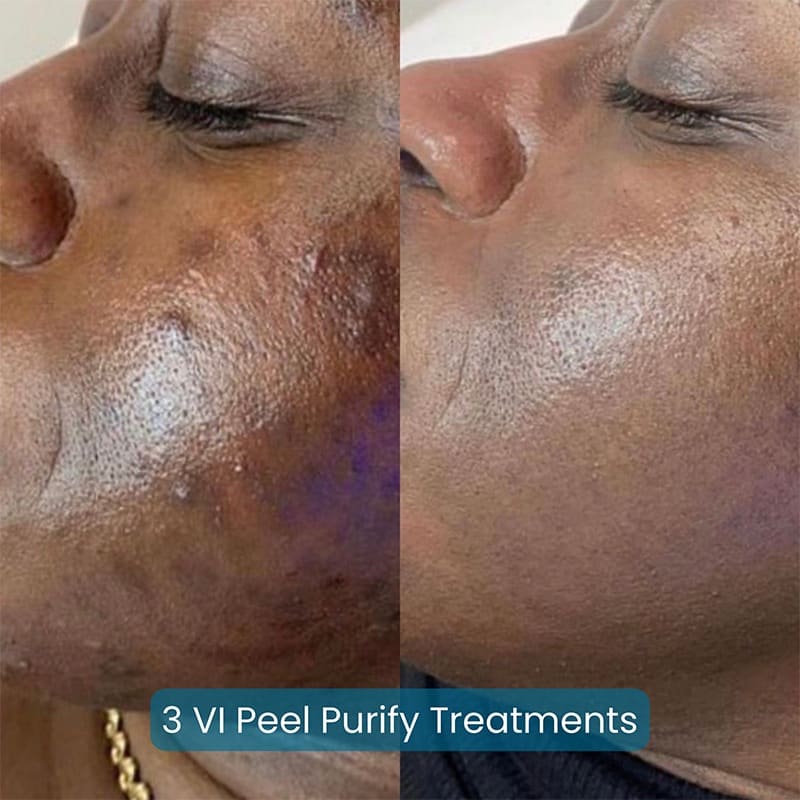 Chemical Peels Before & After Image