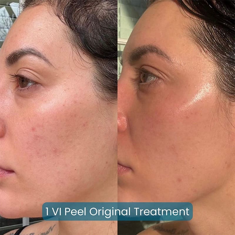 Chemical Peels Before & After Image