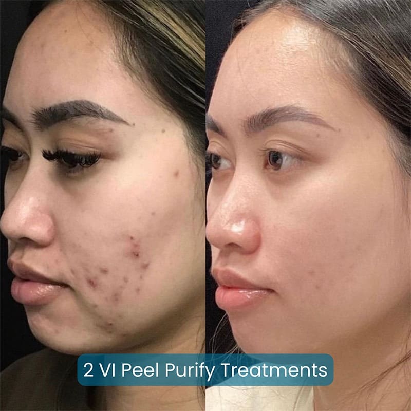 Chemical Peels Before & After Image