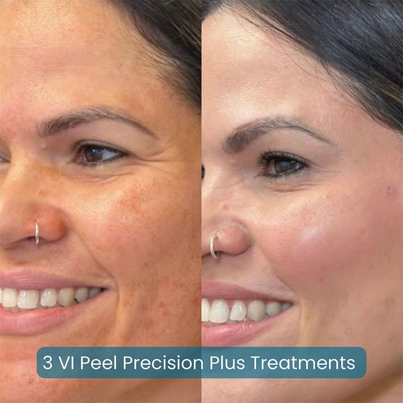 Chemical Peels Before & After Image