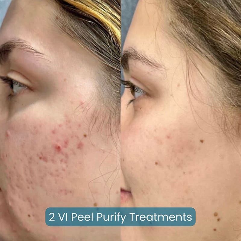 Chemical Peels Before & After Image