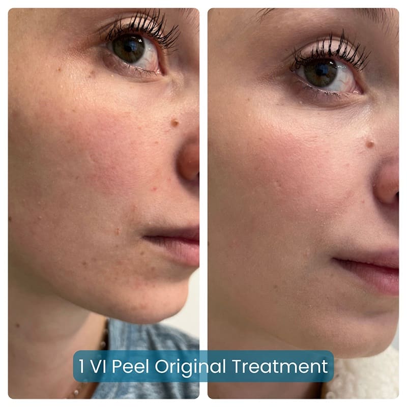 Chemical Peels Before & After Image