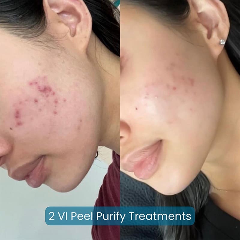 Chemical Peels Before & After Image