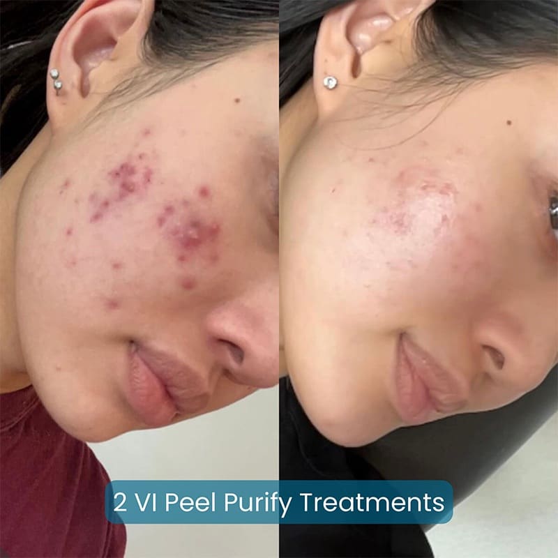 Chemical Peels Before & After Image