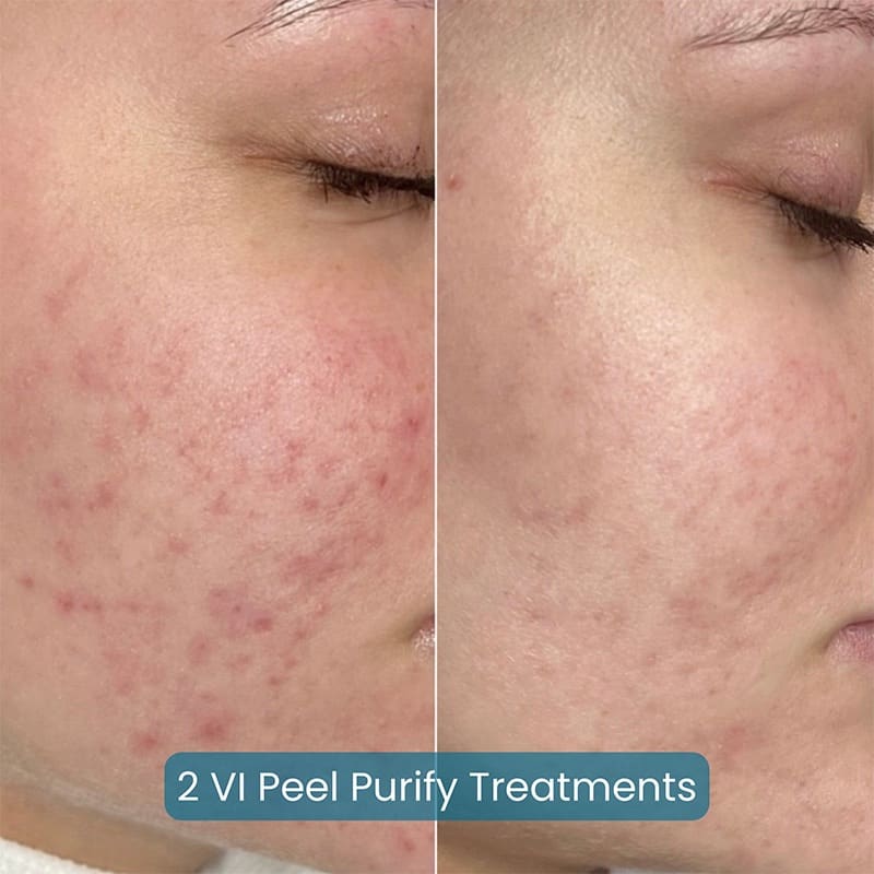 Chemical Peels Before & After Image