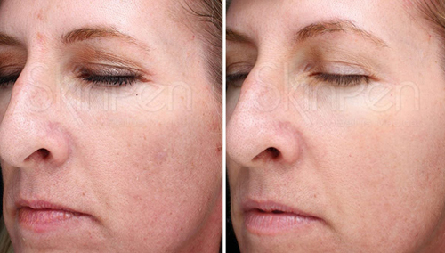 Microneedling  Before & After Image