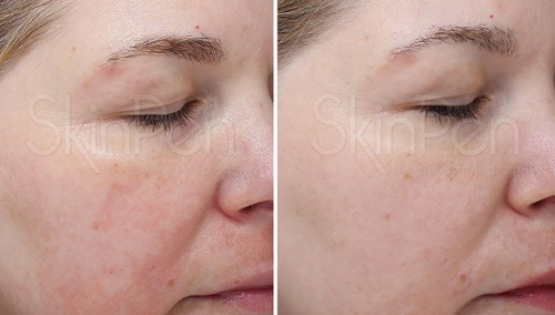Microneedling  Before & After Image